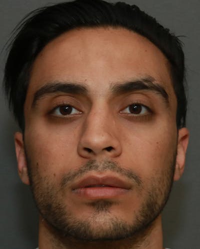 Functional Rhinoplasty Before & After Gallery - Patient 5282751 - Image 1
