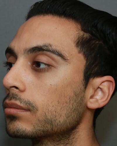 Functional Rhinoplasty Before & After Gallery - Patient 5282751 - Image 4
