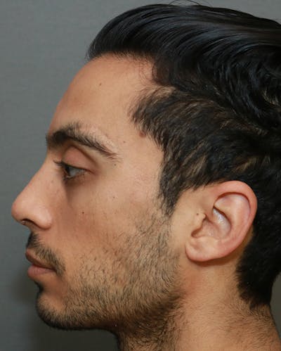 Functional Rhinoplasty Before & After Gallery - Patient 5282751 - Image 6