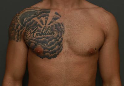 Gynecomastia Before & After Gallery - Patient 5282757 - Image 1
