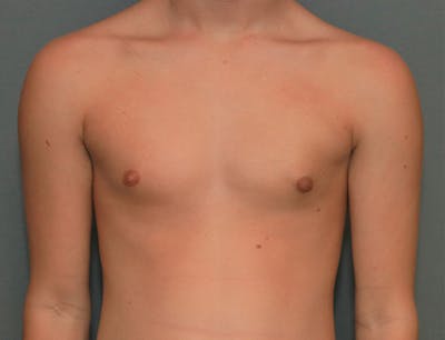 Gynecomastia Before & After Gallery - Patient 8284602 - Image 2