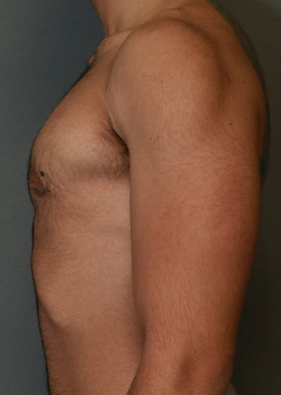 Gynecomastia Before & After Gallery - Patient 8284601 - Image 6