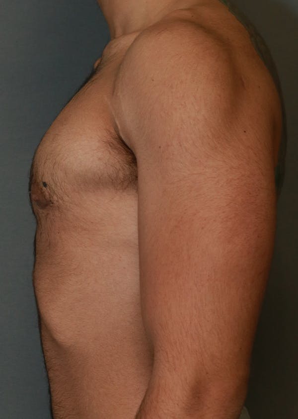 Gynecomastia Before & After Gallery - Patient 8284601 - Image 6
