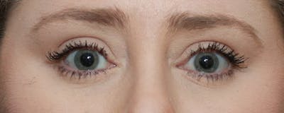 Lower Blepharoplasty Before & After Gallery - Patient 5282807 - Image 2