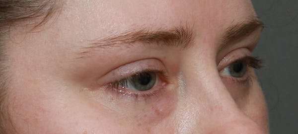 Lower Blepharoplasty Before & After Gallery - Patient 5282807 - Image 3