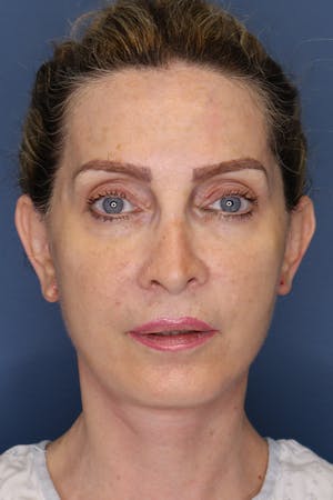Before and After image of Facelift Orange County