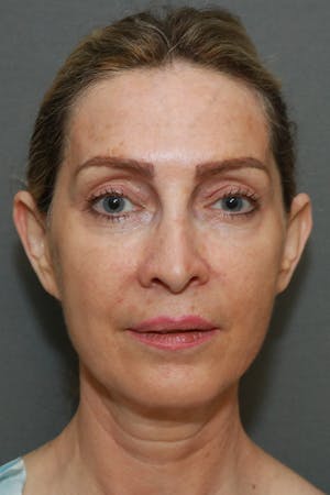 Before and After image of Facelift Orange County