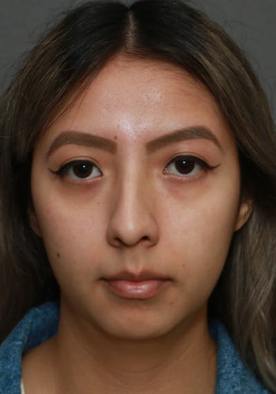 Aesthetic Rhinoplasty Before & After Gallery - Patient 5555942 - Image 1
