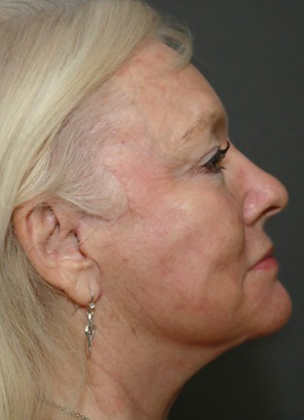 Halo Skin Resurfacing Before & After Gallery - Patient 5556012 - Image 1