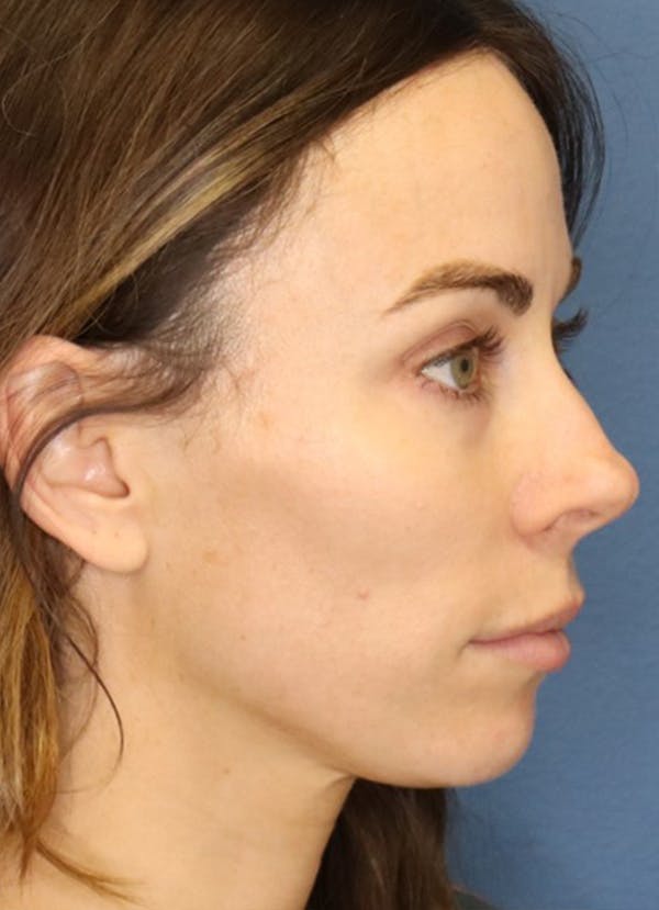 Halo Skin Resurfacing Before & After Gallery - Patient 5556013 - Image 2