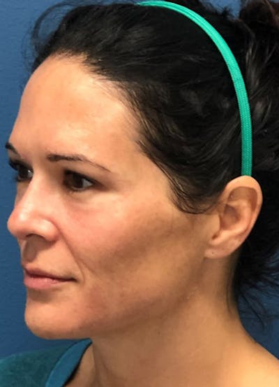Halo Skin Resurfacing Before & After Gallery - Patient 5556014 - Image 1