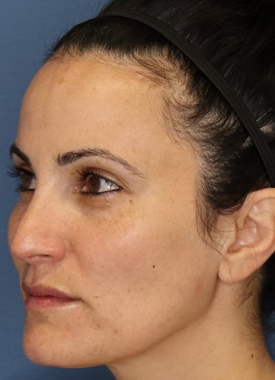 Halo Skin Resurfacing Before & After Gallery - Patient 5556015 - Image 2