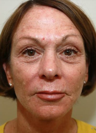 Halo Skin Resurfacing Before & After Gallery - Patient 5556017 - Image 1