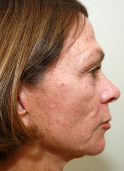 Halo Skin Resurfacing Before & After Gallery - Patient 5556018 - Image 1