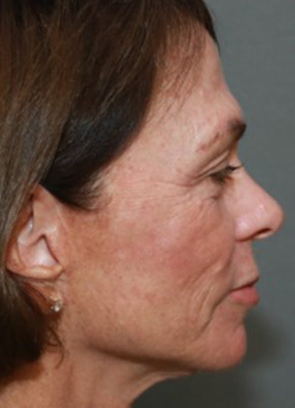 Halo Skin Resurfacing Before & After Gallery - Patient 5556018 - Image 2