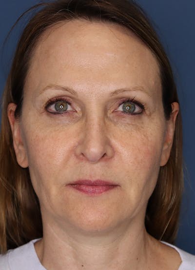 Halo Skin Resurfacing Before & After Gallery - Patient 5556023 - Image 1