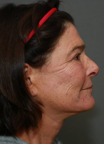 Halo Skin Resurfacing Before & After Gallery - Patient 5556024 - Image 4