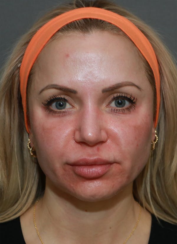 Halo Skin Resurfacing Before & After Gallery - Patient 5556025 - Image 1