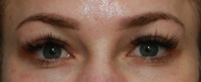 Upper Blepharoplasty Before & After Gallery - Patient 6155684 - Image 2