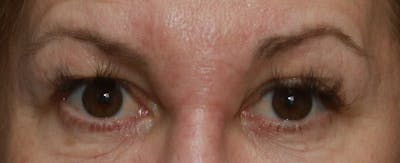 Upper Blepharoplasty Before & After Gallery - Patient 6155685 - Image 1