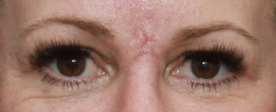 Upper Blepharoplasty Before & After Gallery - Patient 6155685 - Image 2