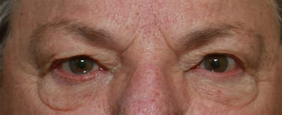 Upper Blepharoplasty Before & After Gallery - Patient 6155686 - Image 1