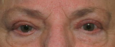 Upper Blepharoplasty Before & After Gallery - Patient 6155686 - Image 2