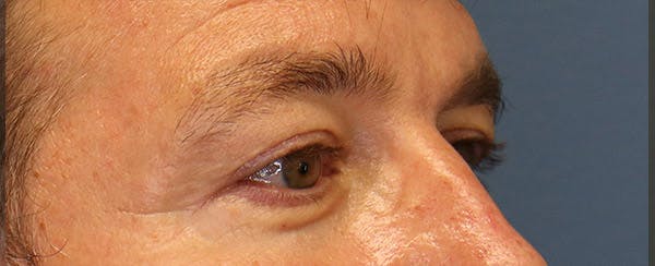 Upper Blepharoplasty Before & After Gallery - Patient 6155687 - Image 2