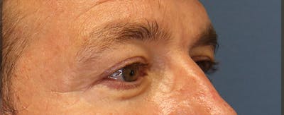 Upper Blepharoplasty Before & After Gallery - Patient 6155687 - Image 2