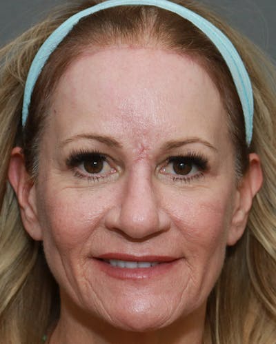 Browlift Before & After Gallery - Patient 6156181 - Image 2