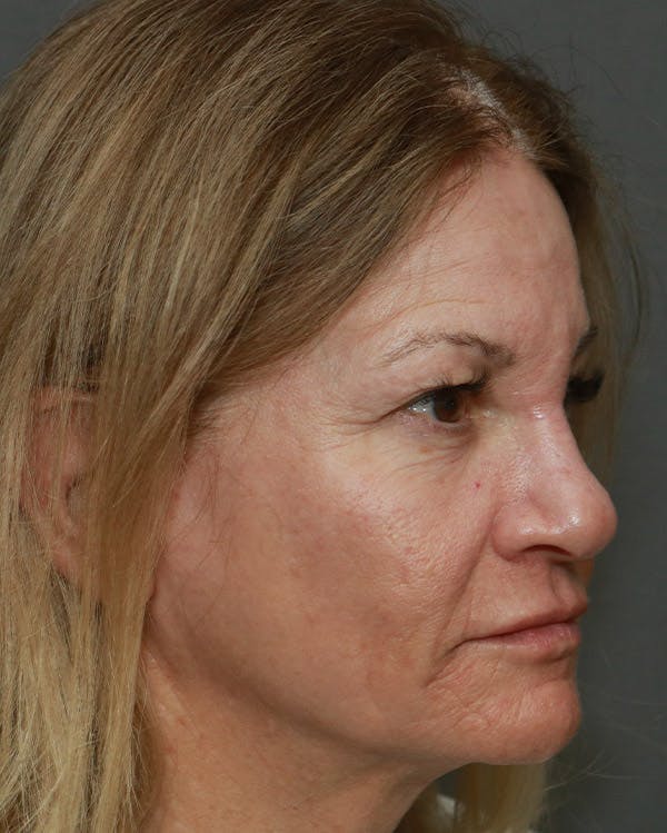 Browlift Before & After Gallery - Patient 6156181 - Image 3