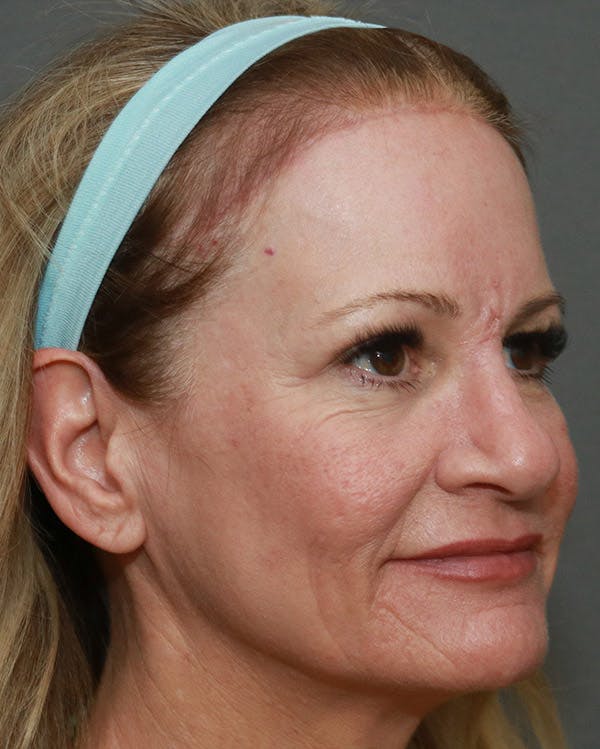 Browlift Before & After Gallery - Patient 6156181 - Image 4