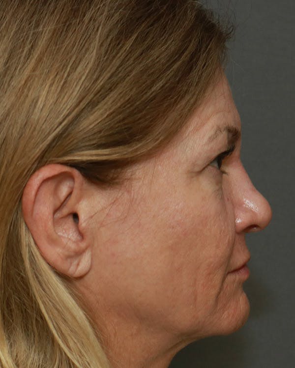Browlift Before & After Gallery - Patient 6156181 - Image 5