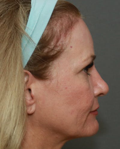 Browlift Before & After Gallery - Patient 6156181 - Image 6