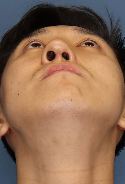 Revision Rhinoplasty Before & After Gallery - Patient 6279570 - Image 10