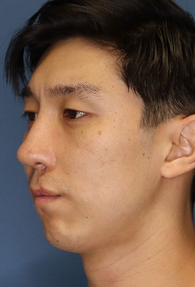 Revision Rhinoplasty Before & After Gallery - Patient 6279570 - Image 4