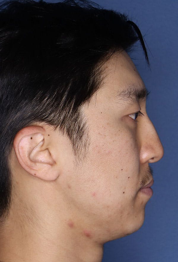 Revision Rhinoplasty Gallery - Patient 6279570 - Image 7