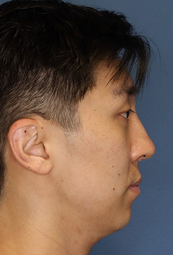 Revision Rhinoplasty Gallery - Patient 6279570 - Image 8