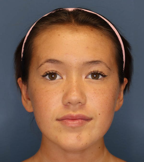 Otoplasty Before & After Gallery - Patient 6610804 - Image 2
