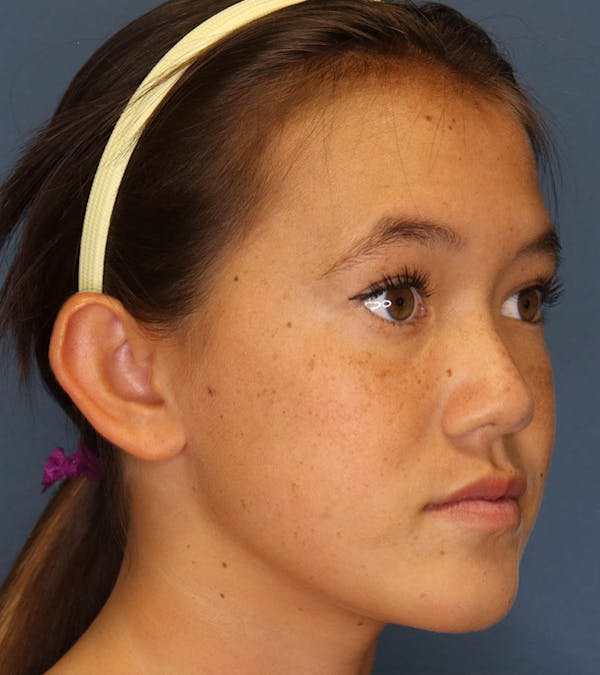 Otoplasty Before & After Gallery - Patient 6610804 - Image 3