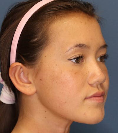 Otoplasty Before & After Gallery - Patient 6610804 - Image 4