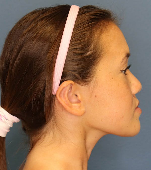 Otoplasty Before & After Gallery - Patient 6610804 - Image 6