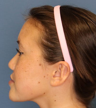 Otoplasty Before & After Gallery - Patient 6610804 - Image 10