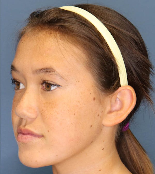 Otoplasty Before & After Gallery - Patient 6610804 - Image 11