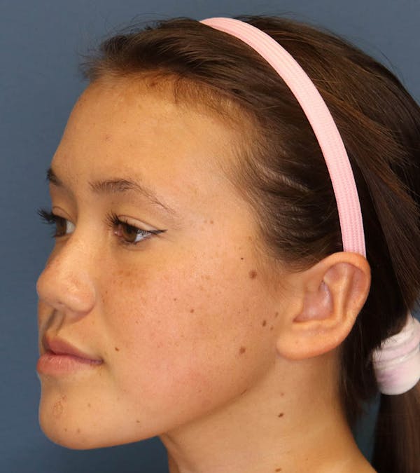 Otoplasty Before & After Gallery - Patient 6610804 - Image 12