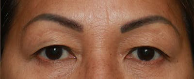 Upper Blepharoplasty Before & After Gallery - Patient 7303604 - Image 1