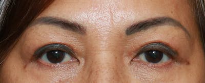 Upper Blepharoplasty Before & After Gallery - Patient 7303604 - Image 2