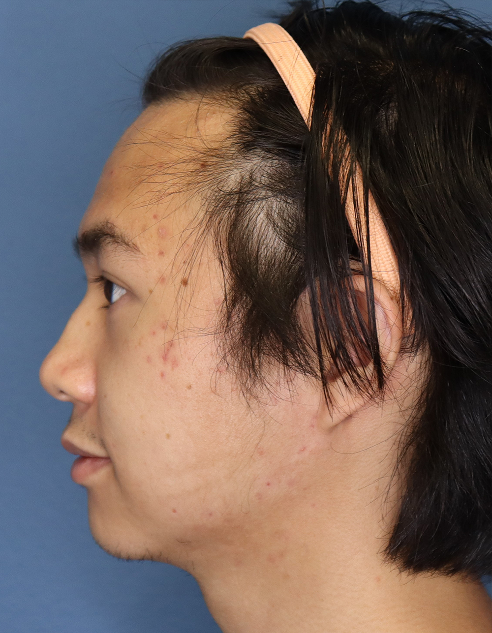 Man's face after frontal - right lateral