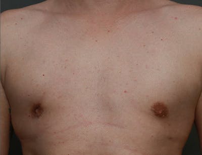Gynecomastia Before & After Gallery - Patient 7329083 - Image 2