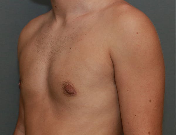 Gynecomastia Before & After Gallery - Patient 7329084 - Image 4